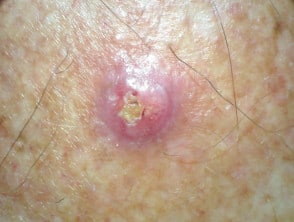 cancer de piele dermatolog chisinau