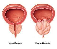 simptome de prostată și prostatita