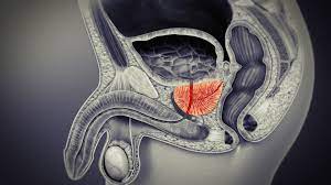 Cum afectează prostatita cronică erecția. Cum afectează prostatita cronică la o erecție?