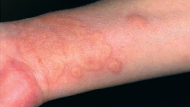 urticaria dermatolog