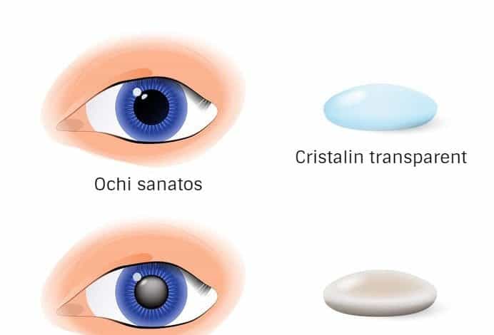 cataracta, consultatie medic oftalmolog