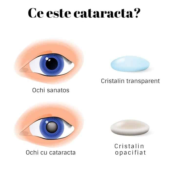 cataracta, consultatie medic oftalmolog