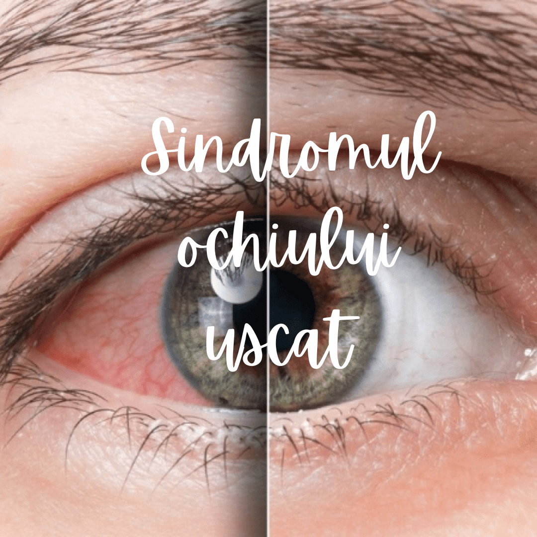 3 sfaturi pentru tratarea sindromului de ochi uscat