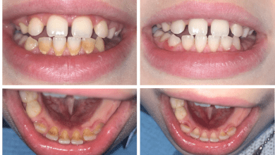Profilaxia cariei dentare