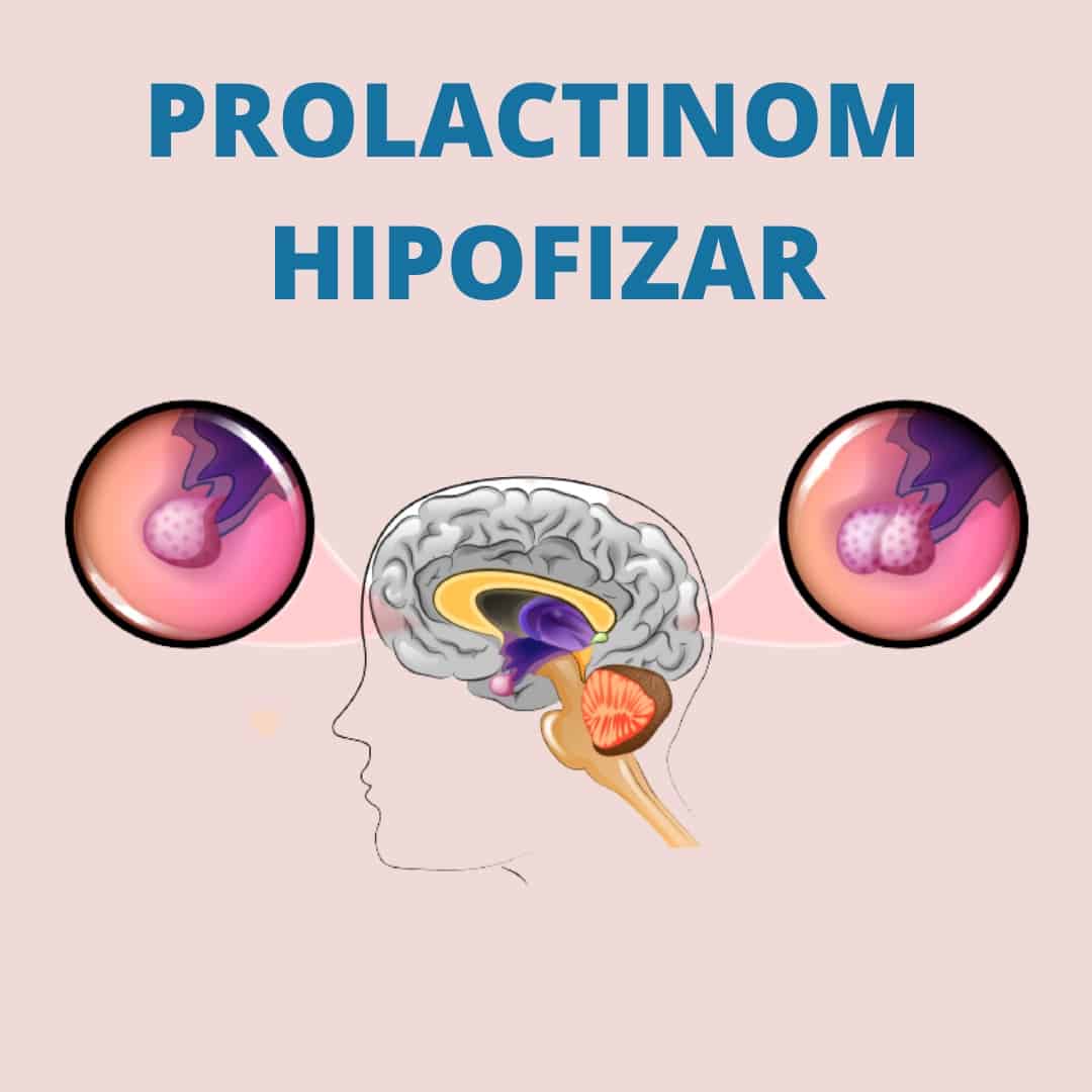 prolactinom