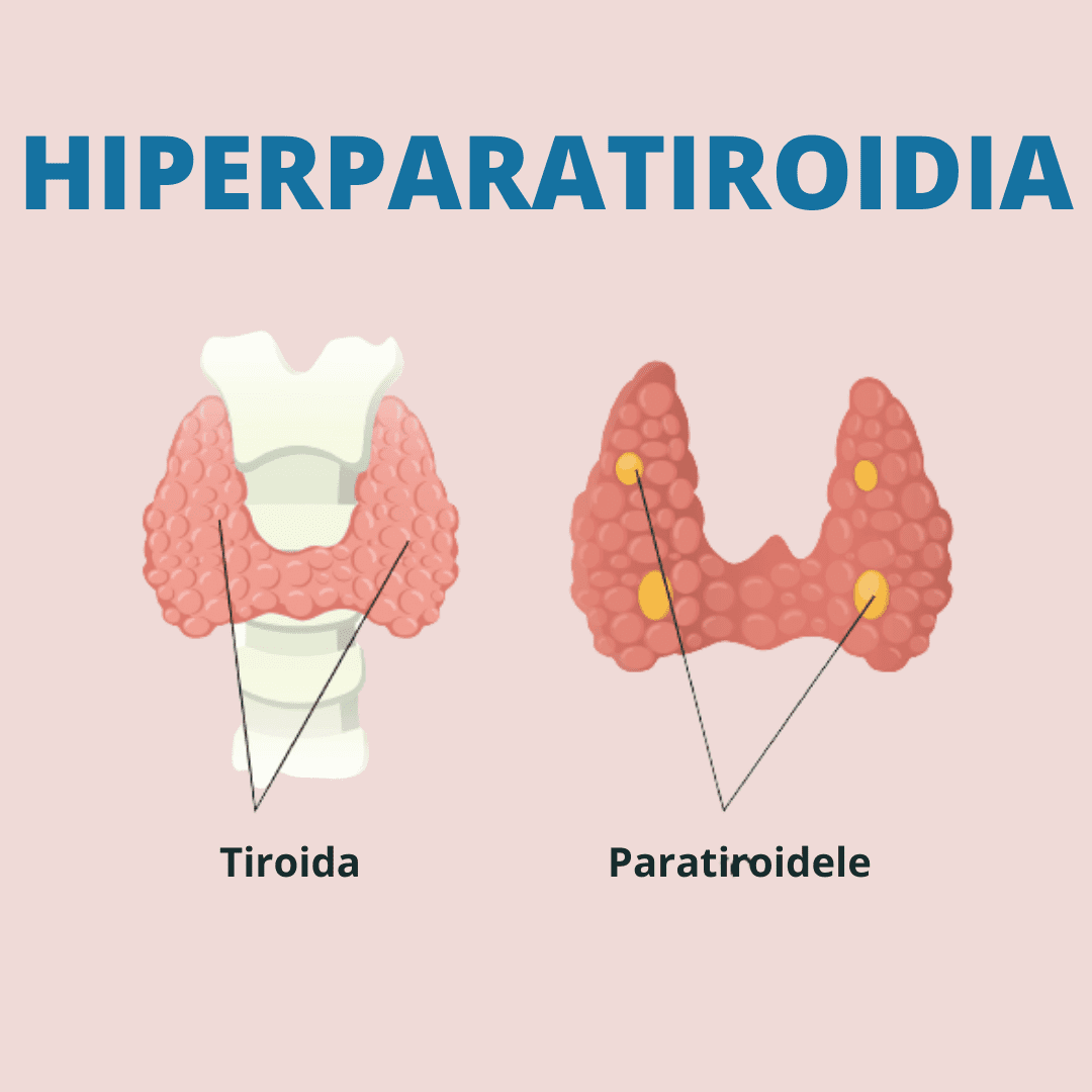 Hiperparotiroida