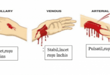 clasificarea hemoragiilor