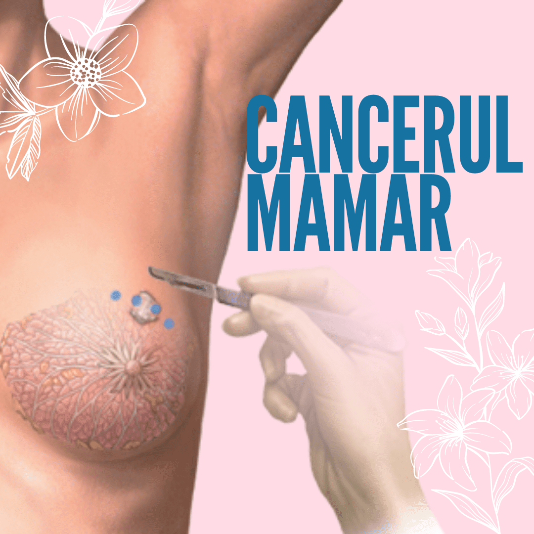 cancer mamar