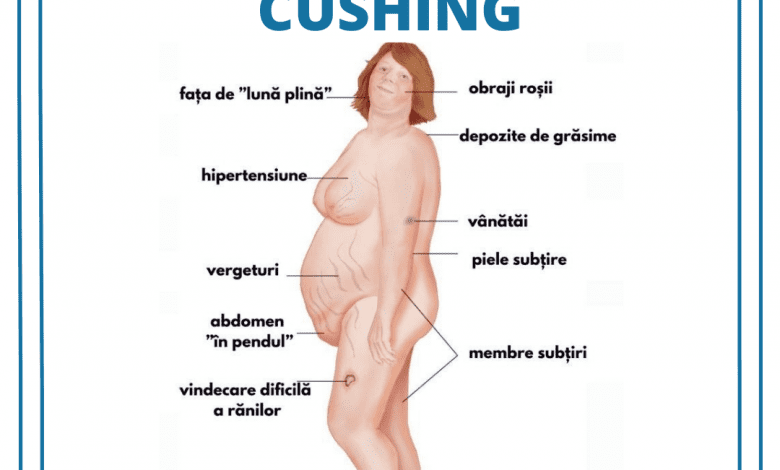 sindromul cushing