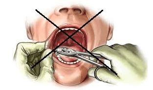 Când sunt contraindicate extracțiile dentare?