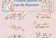 primul ajutor in caz de fracturi