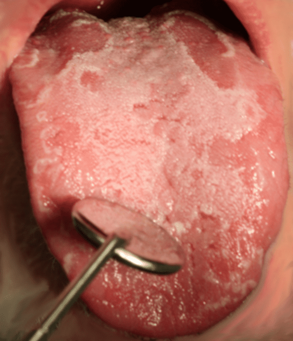 dureri de limba