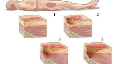 escarele de cubit